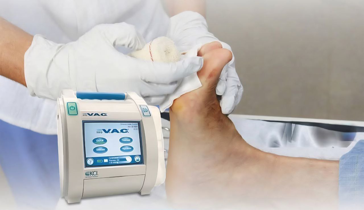 جهاز الفاكيوم لمرضى القدم السكري